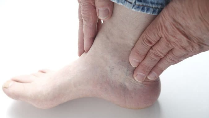 Biểu hiện biến chứng thận ở bệnh nhân tiểu đường