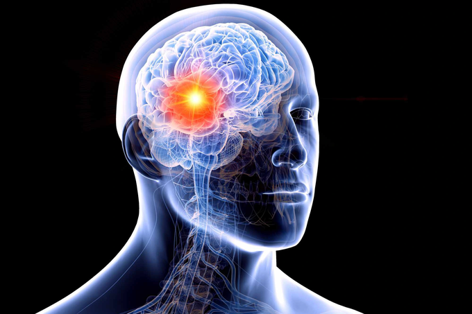 Hay đau đầu vào buổi sáng, giảm thị lực: Coi chừng bệnh nguy hiểm ở não