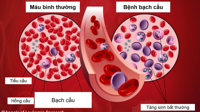 7 dấu hiệu cảnh báo bệnh ung thư máu