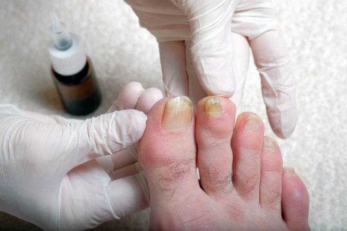 5 dấu hiệu bất thường ở móng chân cảnh báo bệnh