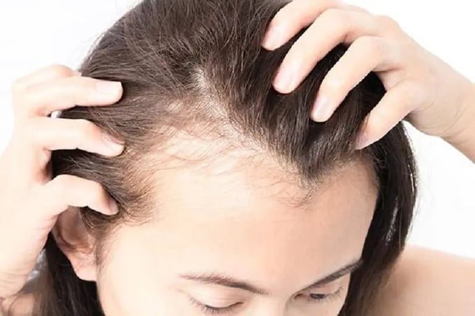 Dấu hiệu bệnh tình dục nguy hiểm khi rụng tóc thường xuyên