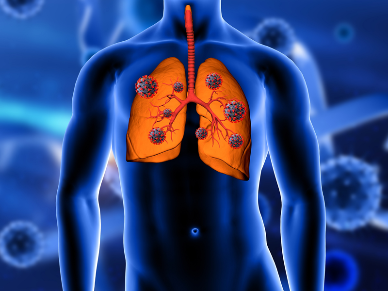 4 dấu hiệu sớm của ung thư phổi mà ai cũng nên biết để kịp thời chữa trị