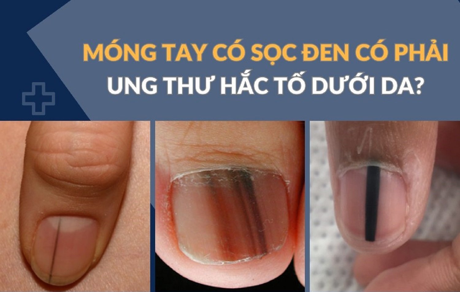 Sọc đen trên móng tay có phải dấu hiệu ung thư hắc tố da?