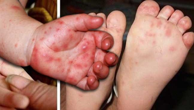Bệnh tay chân miệng đang vào đỉnh dịch: 2 dấu hiệu 'báo động đỏ' cần đưa trẻ đến bệnh viện ngay