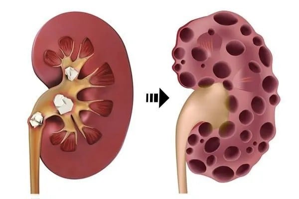 Dấu hiệu cảnh báo chức năng thận bị suy giảm