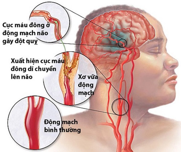 Dấu hiệu nhận biết đột quỵ, nguyên nhân và cách phòng tránh