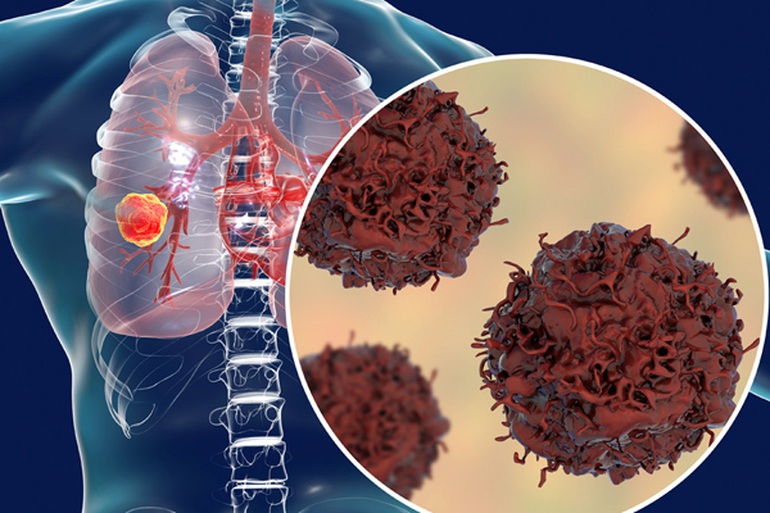 5 triệu chứng tiềm ẩn của ung thư phổi nhiều người không ngờ tới