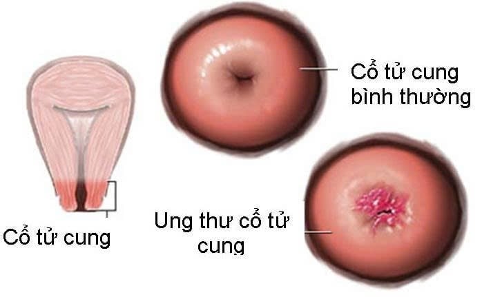 Dấu hiểu cảnh báo K cổ tử cung sớm