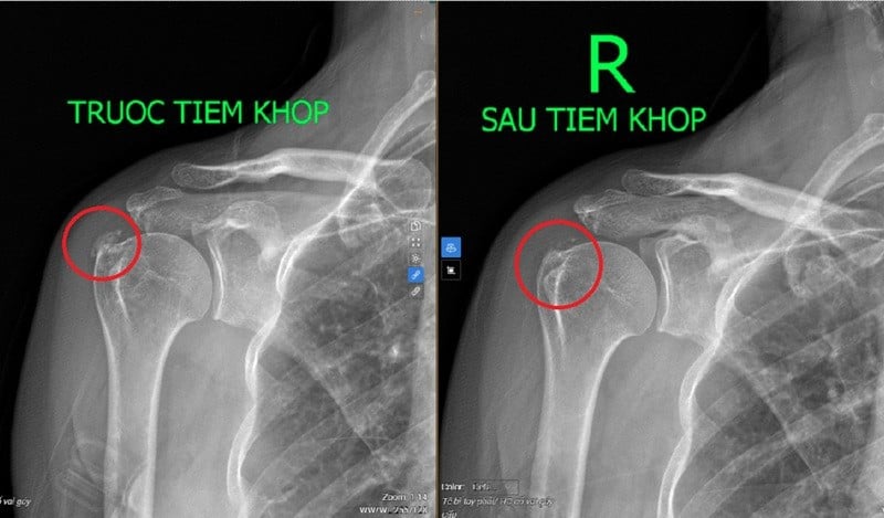 Đau vai cả tháng, người phụ nữ phát hiện viêm gân vôi hóa
