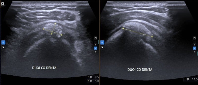 Đau vai cả tháng, người phụ nữ phát hiện viêm gân vôi hóa